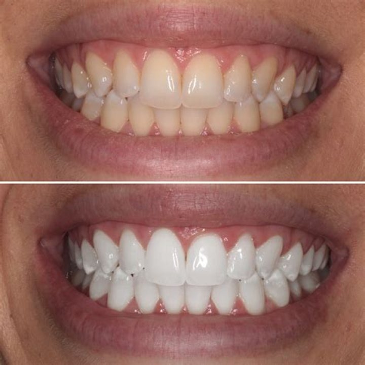 Brilliant Chrome Dental Implants: Long-Lasting Smiles